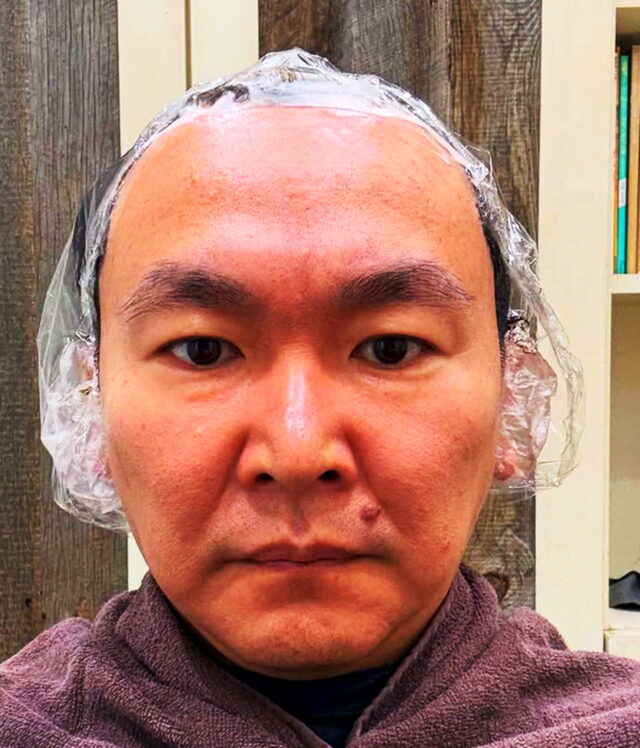 山瀬まみの脳梗塞になった理由はなぜ？何がん？足切断とは何なのか